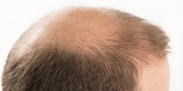 La strategia definitiva per finasteride result