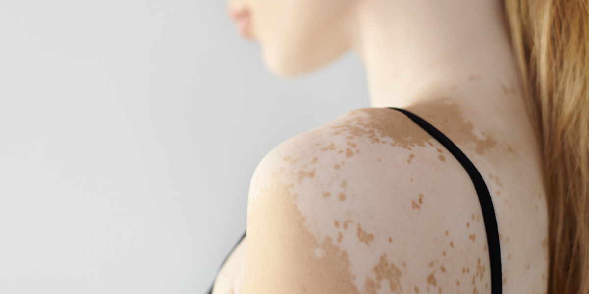 ragazza che soffre di vitiligine vista dal lato della spalla con macchie di bianco